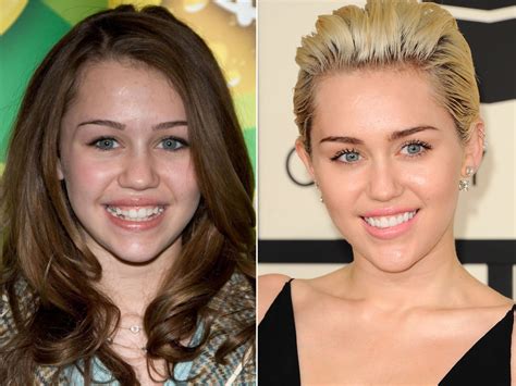 miley cyrus before and after plastic surgery